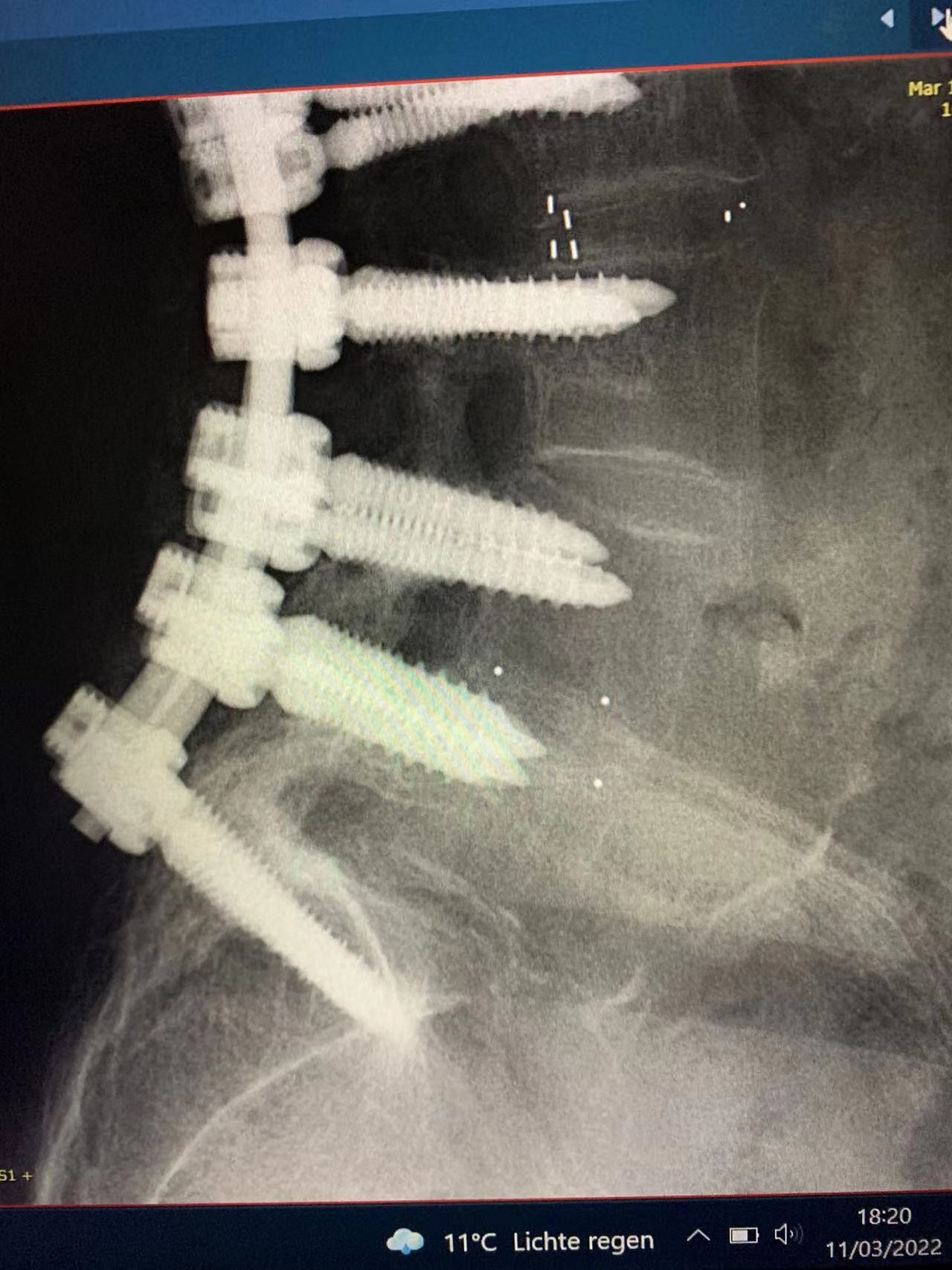 Latest company case about Successful Spinal Surgical Internal Fixation
