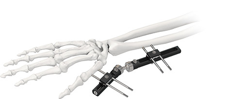 Orthopedic Wrist External Fixator Standard Single sided Integrated
