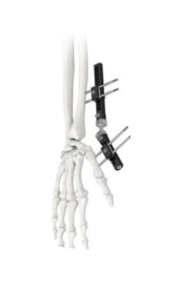 Orthopedic Wrist External Fixator Standard Single sided Integrated