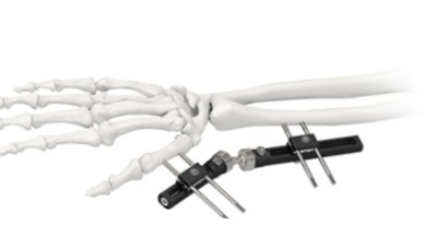 Orthopedic Wrist External Fixator Standard Single sided Integrated