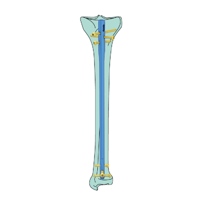 8/9/10 Mm Thickness Titanium Intramedullary Nail System Proximal Tibial Interlocking Nail