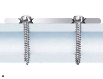 Ulna Radius Dcp Dynamic Compression Plate Ortho Class IIb