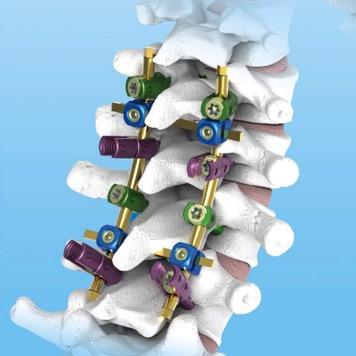 6.0 Double Thread U Multi Axial Break Off Pedicle Screw Spinal Internal Fixation 0