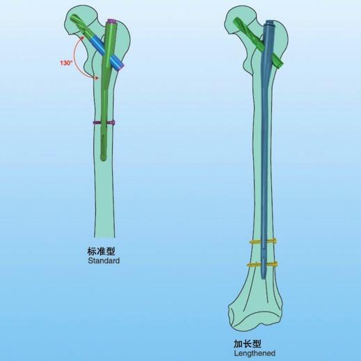 Valid Time 3 Years PFNA Interlocking Femoral Nail System CE ISO13485 Thickness 9/10/11/12 Mm 0