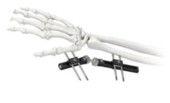 Orthopedic Wrist External Fixator Standard Single sided Integrated 0