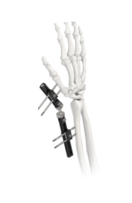 Orthopedic Wrist External Fixator Standard Single sided Integrated 1