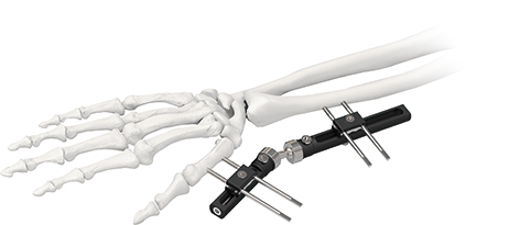 Orthopedic Wrist External Fixator Standard Single sided Integrated 2
