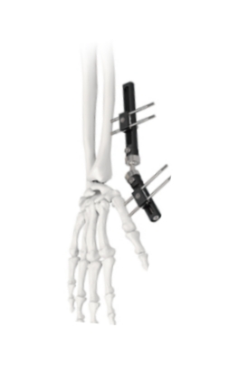 Orthopedic Wrist External Fixator Standard Single sided Integrated 3