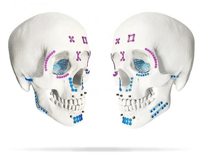 Maxillofacial Mini Locking L Plate 1.0mm System Thickness Titanium 1