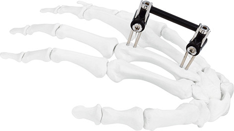 Hand Bone Pin Stent Radius Mini External Fixator Ortho Combined Type 0