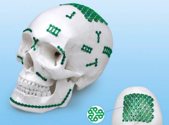 CE ISO 13485 Maxillofacial Plating System Titanium Bone Implants 1